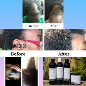 Hair growth serum!  bald spots, edges, hair lines!
